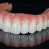 Full ARCH IMPLANT RESTORATION 