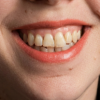Crown Lengthening Before
