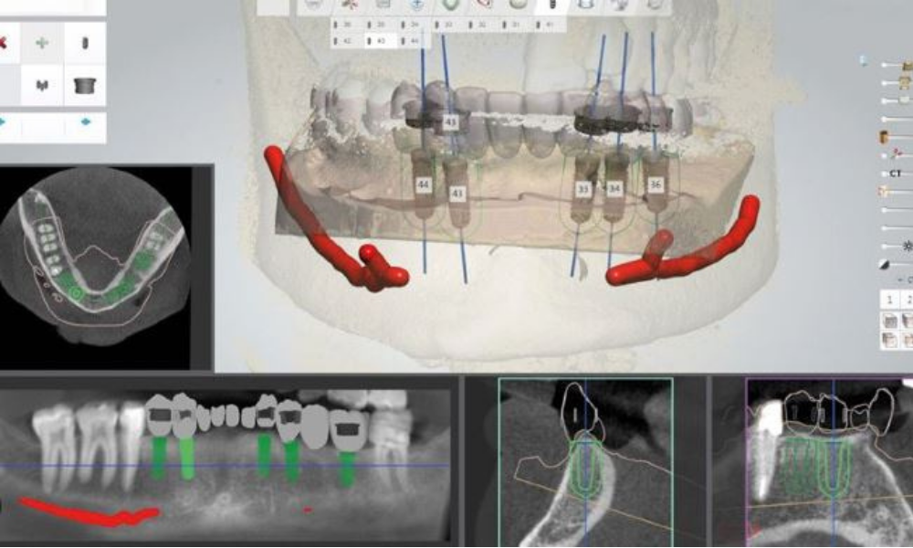 Implant Planning - Surgical Guide 