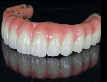 Full ARCH IMPLANT RESTORATION 