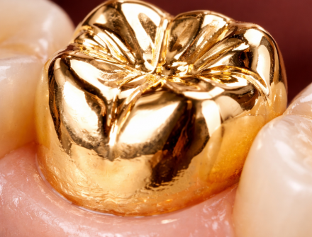 Edentalab - Full metal crown